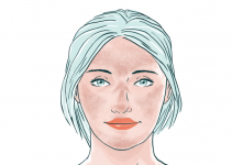 Melasma: sintomas, tratamento e cuidados